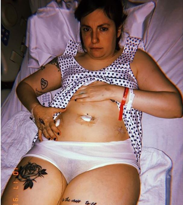 Lena Dunham: "Trovarsi calva per una malattia autoimmune"