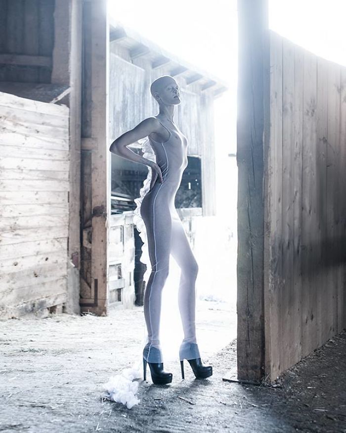 Melanie, top model nonostante la sua rara malattia genetica