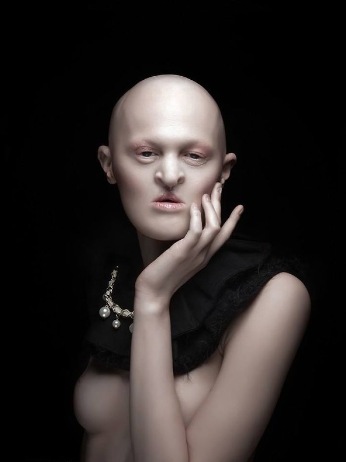 Melanie, top model nonostante la sua rara malattia genetica