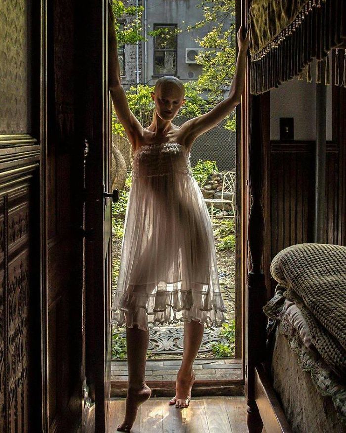 Melanie, top model nonostante la sua rara malattia genetica