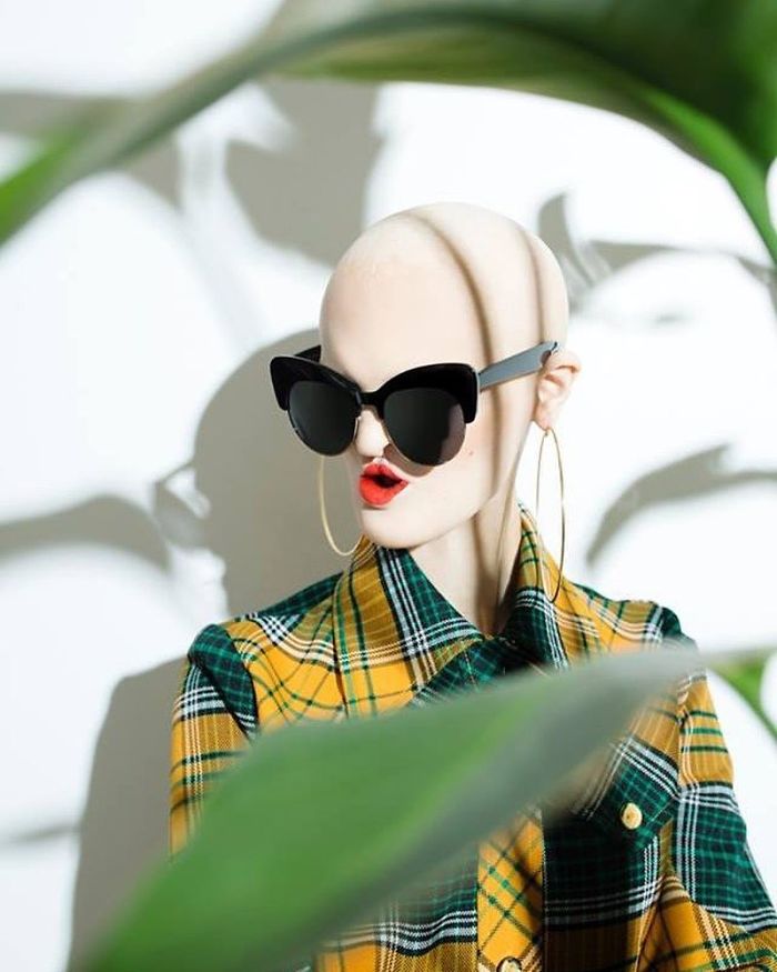 Melanie, top model nonostante la sua rara malattia genetica