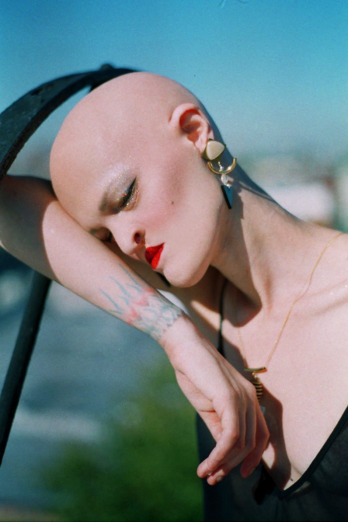 Melanie, top model nonostante la sua rara malattia genetica