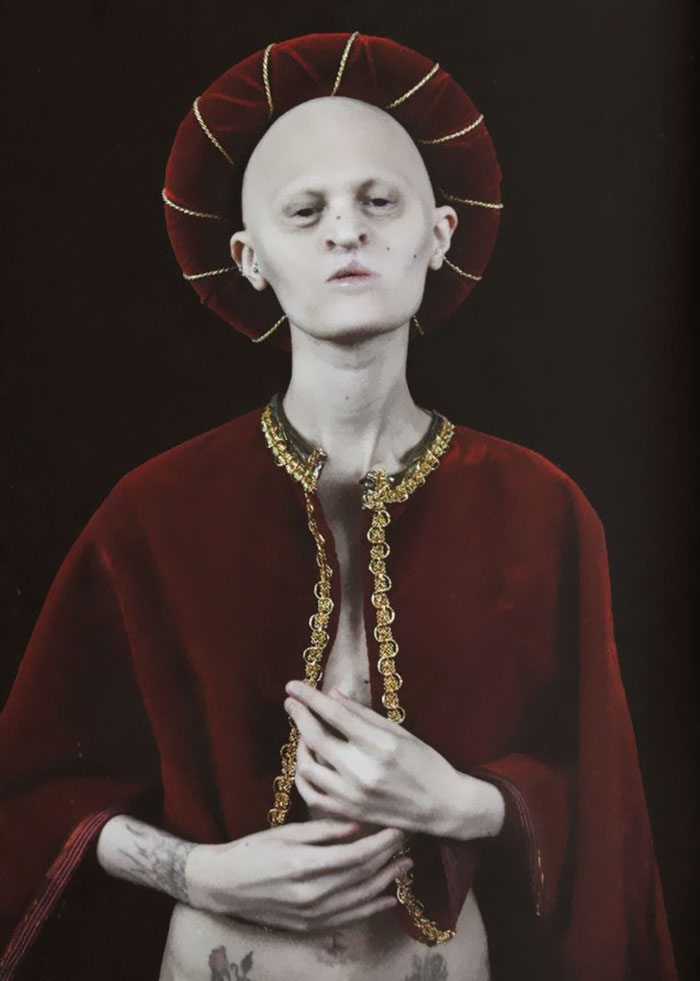Melanie, top model nonostante la sua rara malattia genetica