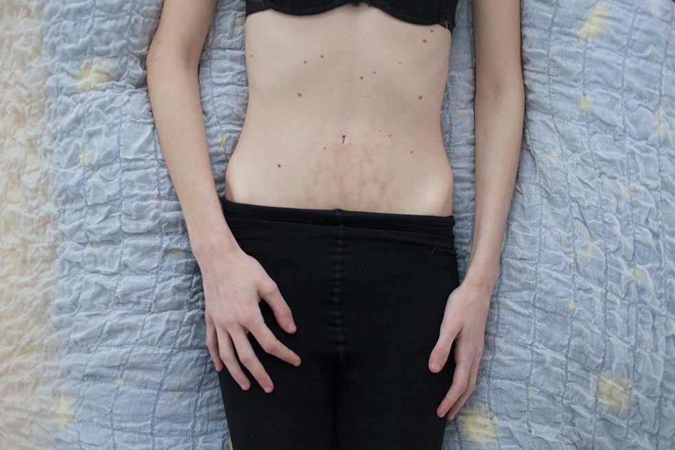 "Voglio sparire": il dramma dei disturbi alimentari in 11 foto