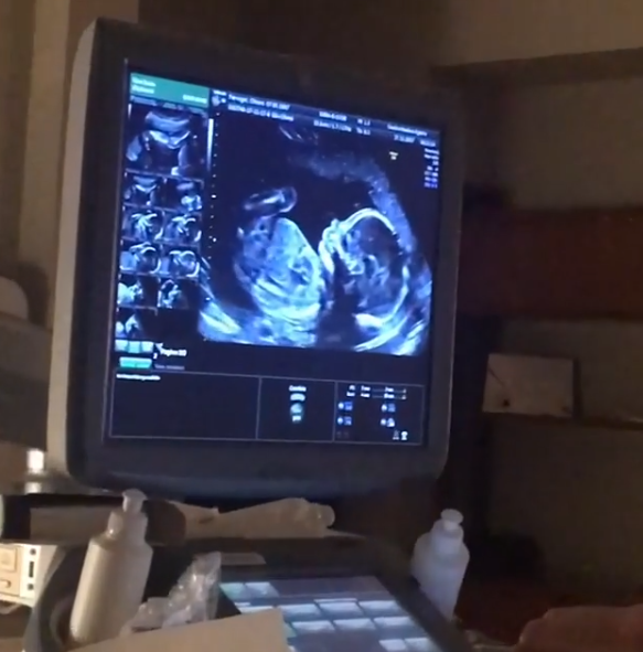 Ferragni e Fedez, baby raviolo in arrivo