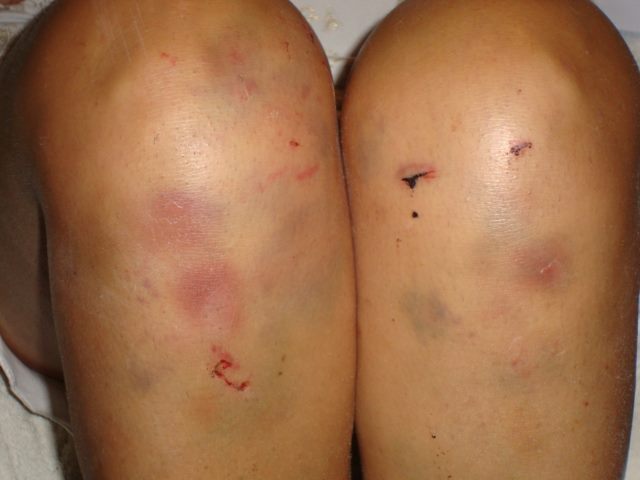 Lidia Vivoli: "Vi mostro il mio corpo dilaniato da chi mi chiamava 'amore'"