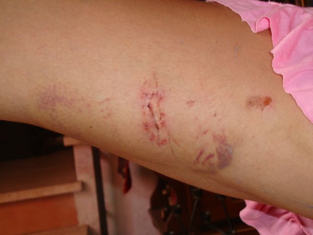 Lidia Vivoli: "Vi mostro il mio corpo dilaniato da chi mi chiamava 'amore'"