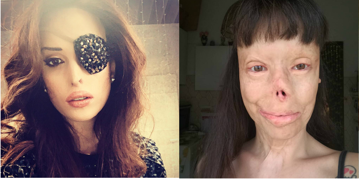 "Tu con l'uncino, io con la benda": la forza di Gessica Notaro e Valentina Pitzalis