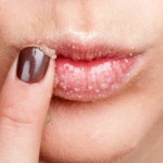 Labbra secche o screpolate: cause, sintomi e rimedi
