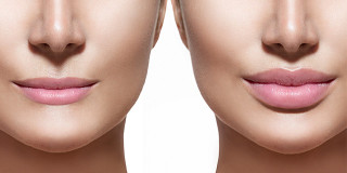 Filler labbra