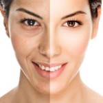 Fotoringiovanimento con luce pulsata: di cosa si tratta?