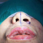 Lip reduction: basta labbra a canotto, ora si fanno rimpicciolire