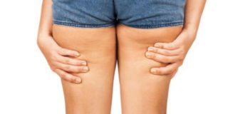 Cellulite e rotolini