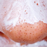 Skin gritting, come funziona il trattamento che fa "uscire" i punti neri da soli