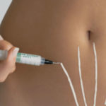 Eliminare le smagliature (e le rughe) con la biodermogenesi