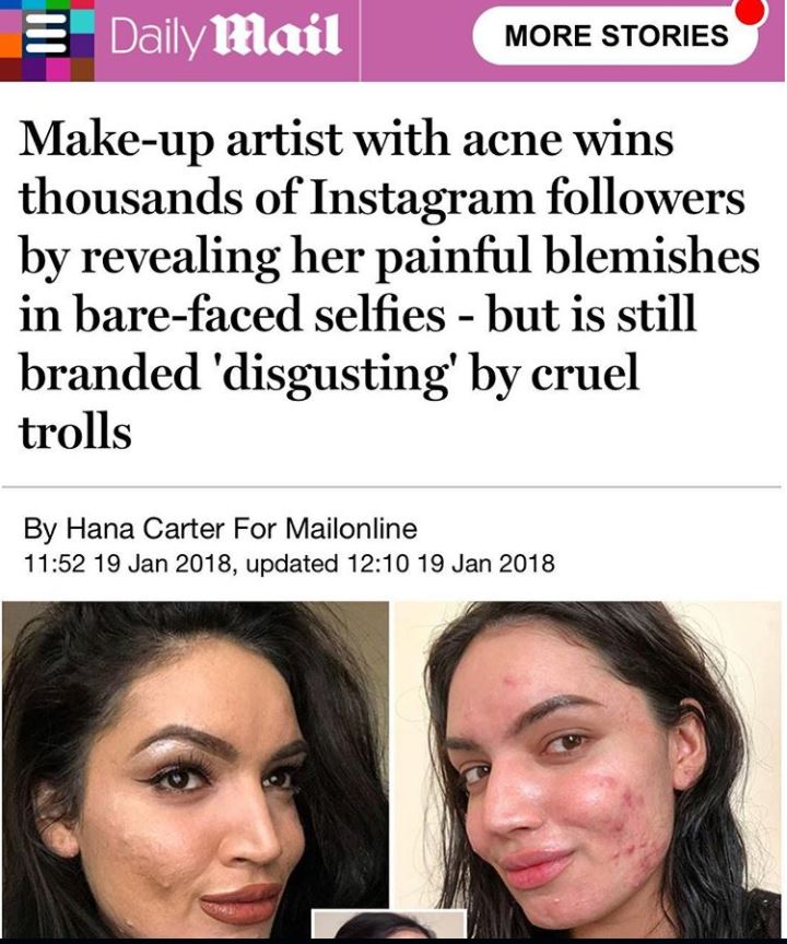 "La mia pelle non mi impedisce di amarmi ed essere una beauty blogger"