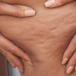 Mesoterapia: la medicina alternativa che combatte la cellulite
