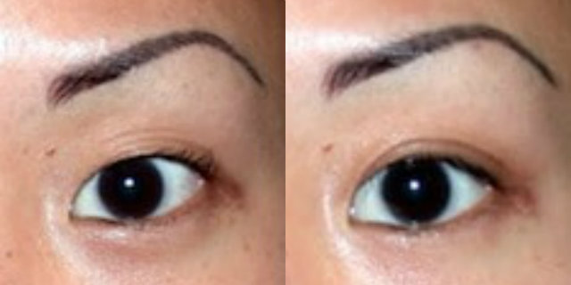 Blefaroplastica: prima e dopo