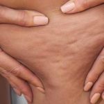 Rimedi cellulite: 6 consigli davvero efficaci e 6 bufale mangiasoldi da ignorare