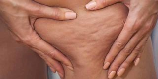 rimedi cellulite